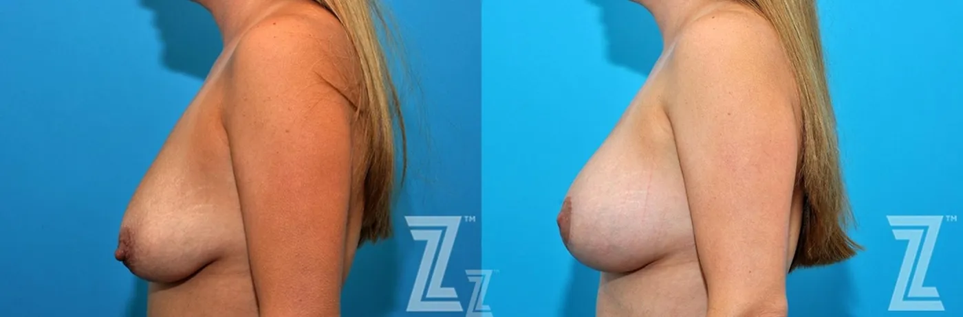 Austin Side breast view before and after images 36 year old woman 1 year post op mommy makeover - Austin Tx, The Piazza Center - The Piazza Center
