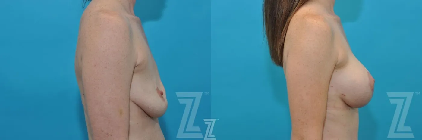 Austin Lateral Breast view before & after images of 35 year old woman mommy make over - Dr. Rocco Piazza Austin TX - The Piazza Center