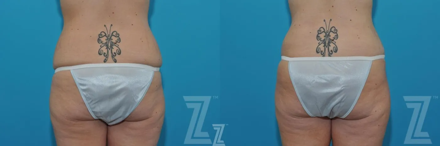 Austin Liposuction Before & After Gallery - Patient 132903278 - Image 6 - The Piazza Center