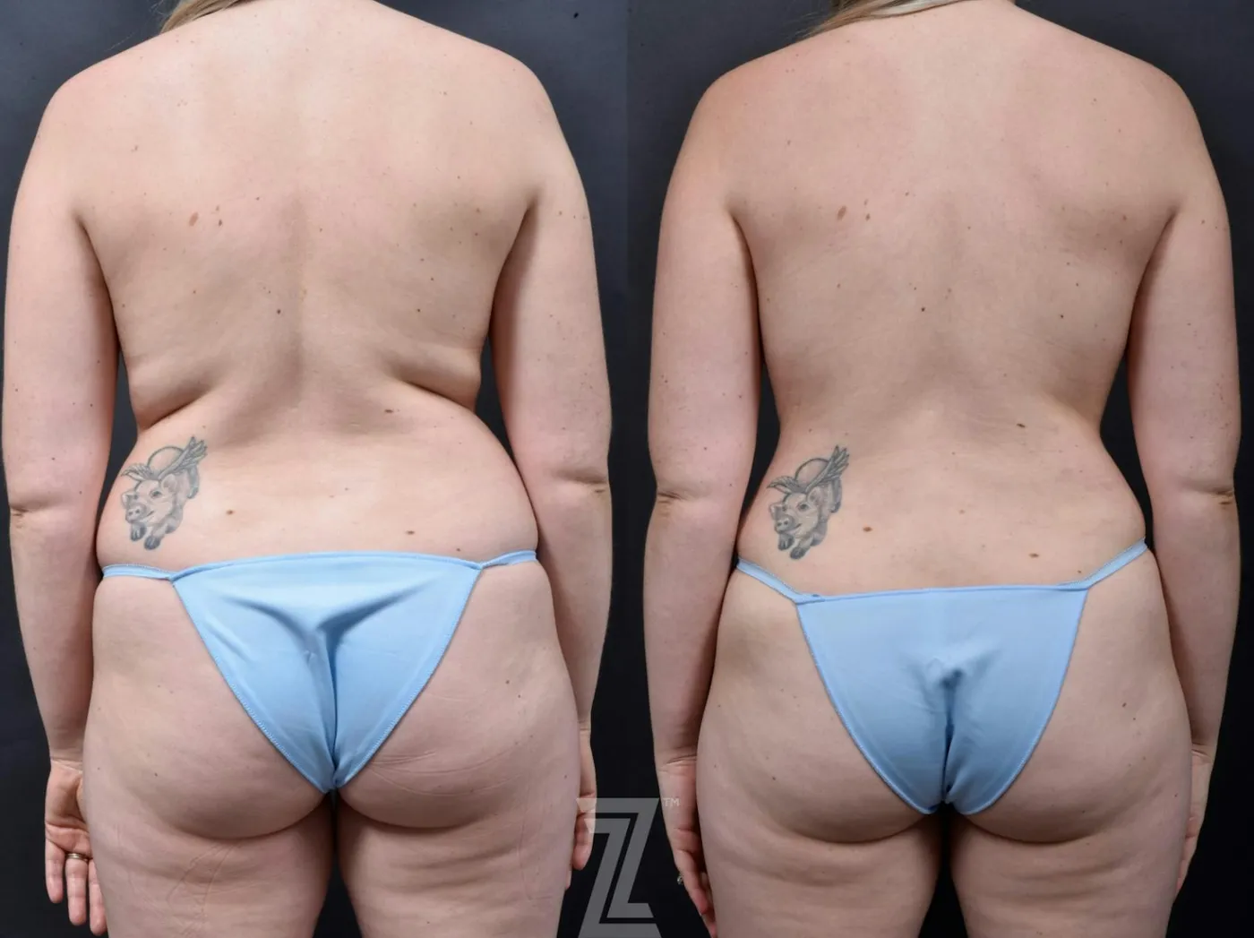 Austin 29-Year-Old Mommy Makeover Before & After by Dr. Rocco Piazza in Austin, Texas - Posterior View - The Piazza Center
