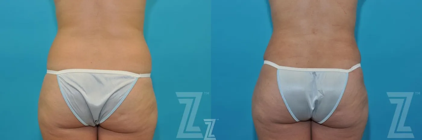Austin Before & After images posterior view of 40-year-old mother of five mommy maker over - Dr. Rocco Piazza, Austin TX - The Piazza Center