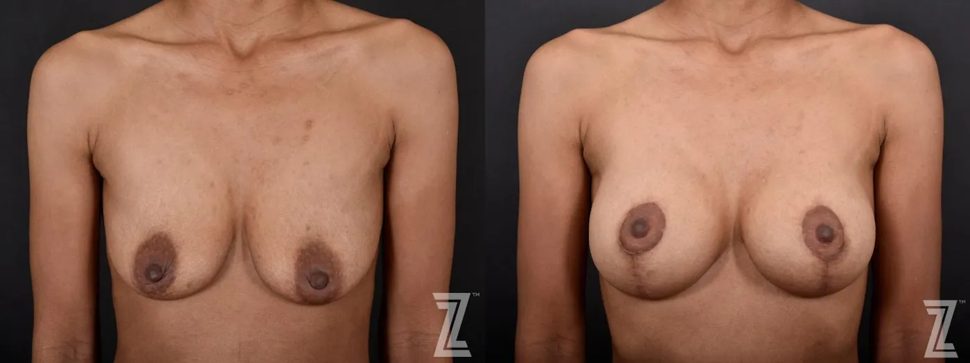 Austin Frontal View of Breast of 34-Year-Old Mom of Three Children Mommy Makeover Before & After by Dr. Rocco Piazza in Austin, Texas - The Piazza Center