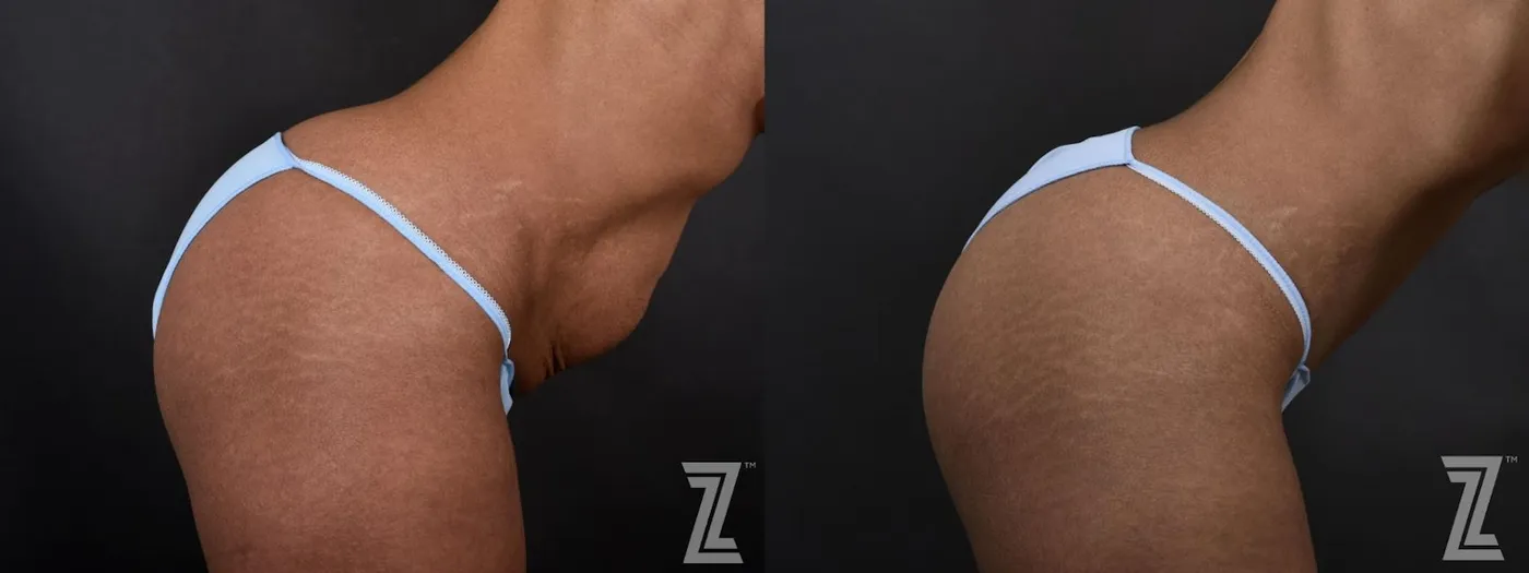 Austin Lateral View of Abdomen in Flexion of 34-Year-Old Mom, with Three Children - Mommy Makeover Before & After by Dr. Rocco Piazza in Austin, Texas - The Piazza Center