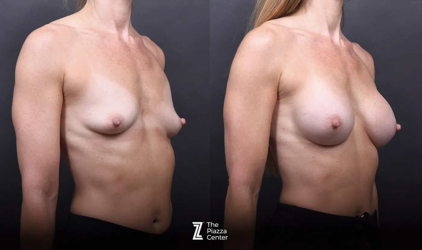 Austin Motiva Implants Before & After Gallery - Patient 245459 - Image 2 - The Piazza Center