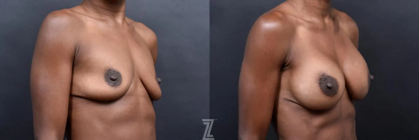 Austin oblique before and after view of 33 year old athletic mom of two children breast augmentation - The Piazza Center