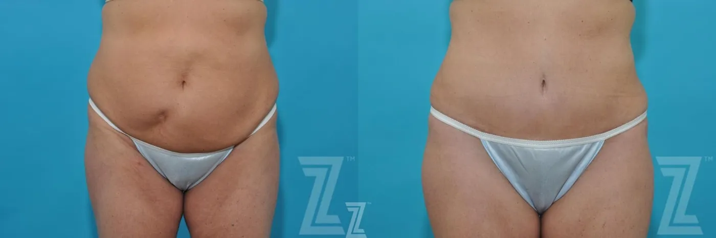 Austin Liposuction Before & After Gallery - Patient 132887306 - Image 1 - The Piazza Center