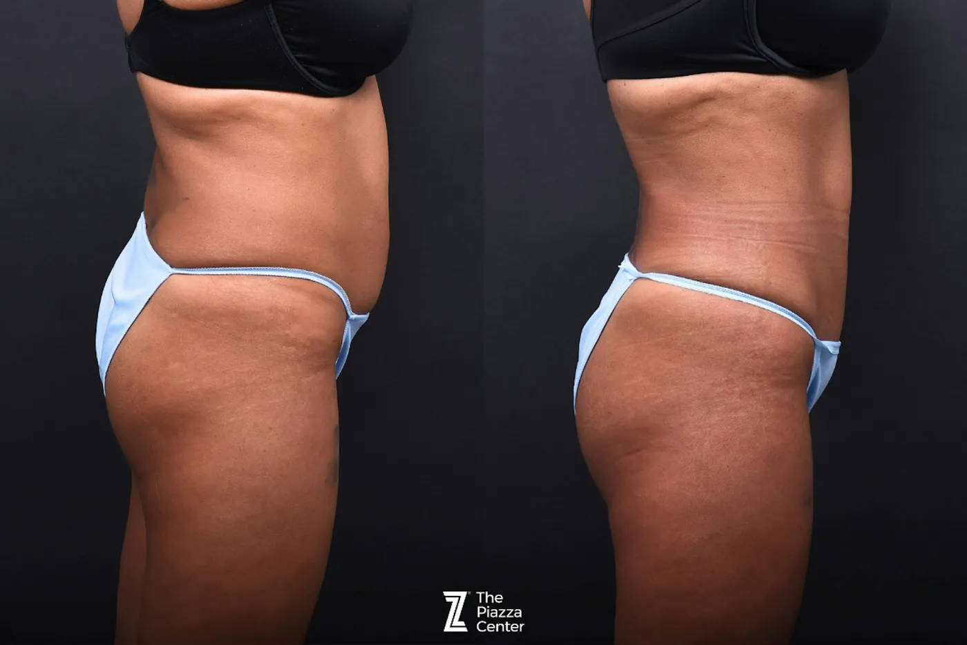 Austin Liposuction Before & After Gallery - Patient 495412 - Image 2 - The Piazza Center