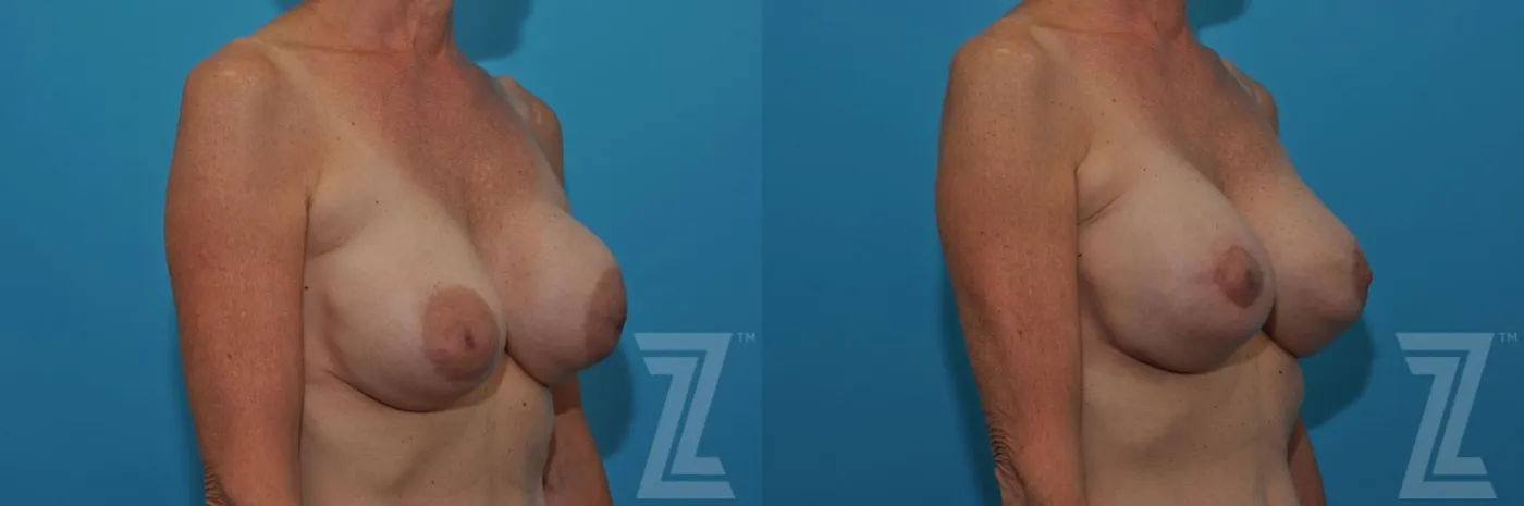 Austin Breast Augmentation Revision Before & After Gallery - Patient 132886537 - Image 3 - The Piazza Center