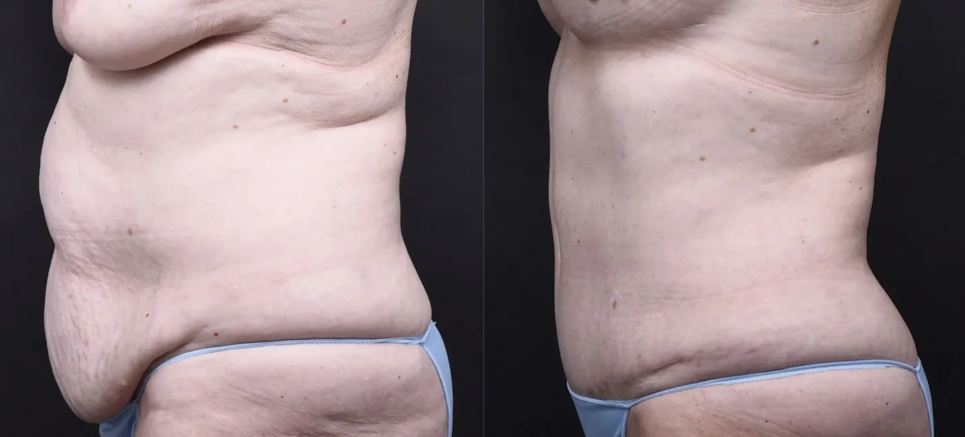 Austin Breast Augmentation With a Breast Lift Before & After Gallery - Patient 438571 - Image 7 - The Piazza Center