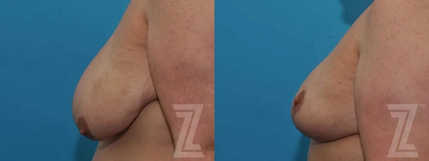 Austin Breast Reduction Before & After Gallery - Patient 132886599 - Image 3 - The Piazza Center
