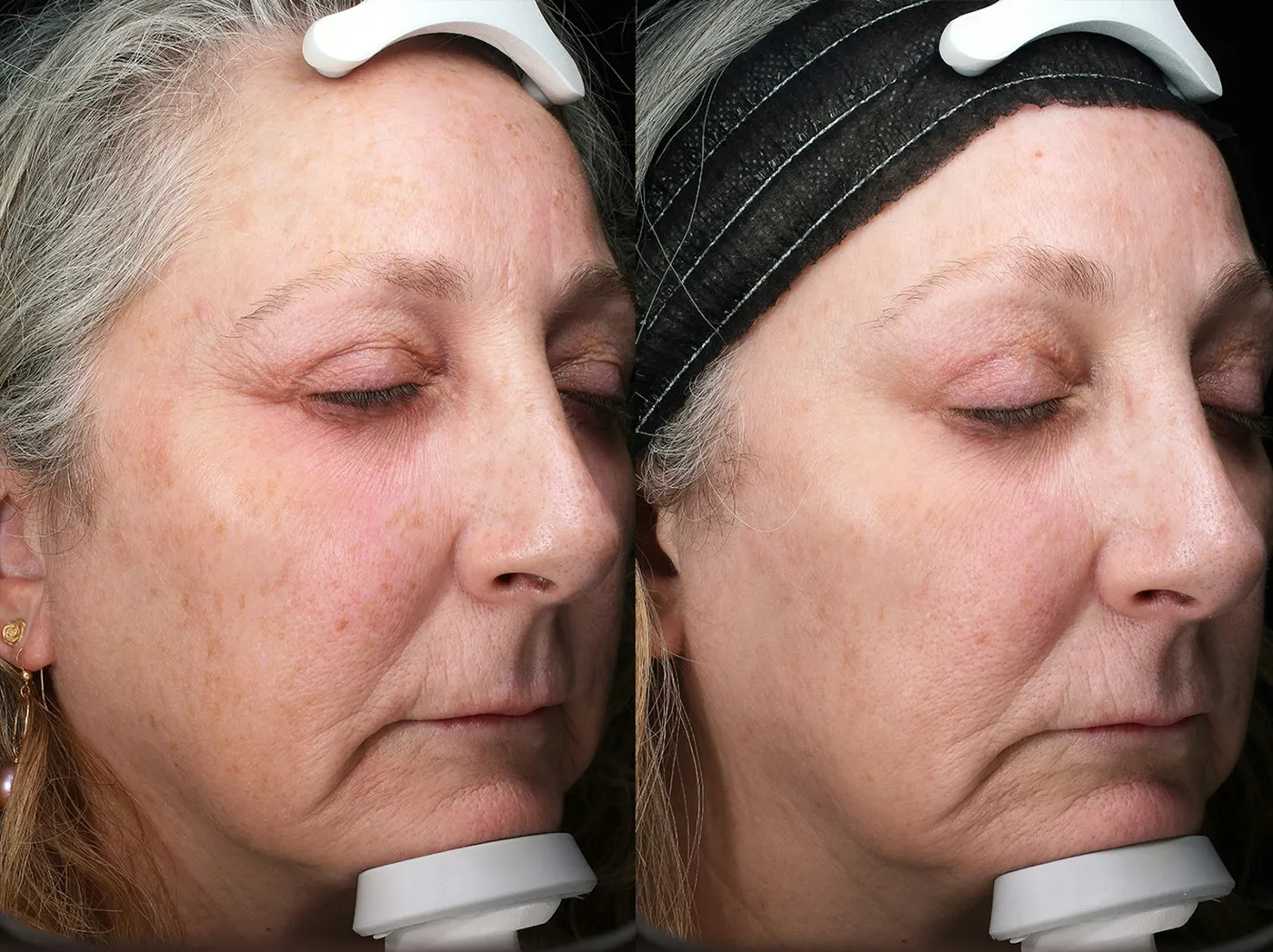 Austin Moxi Before & After Gallery - Patient 200681 - Image 2 - The Piazza Center