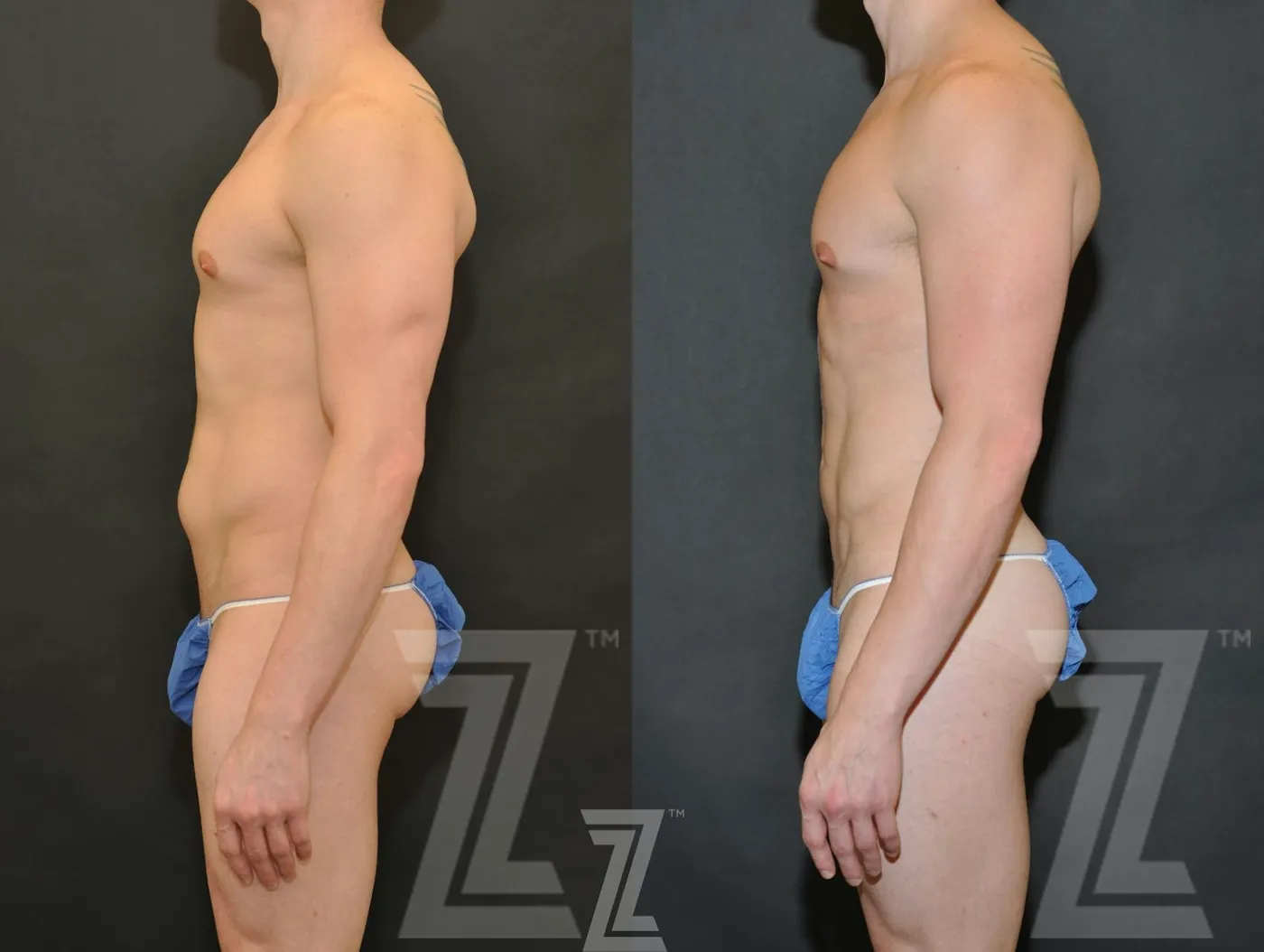 Austin Liposuction Before & After Gallery - Patient 132893823 - Image 3 - The Piazza Center