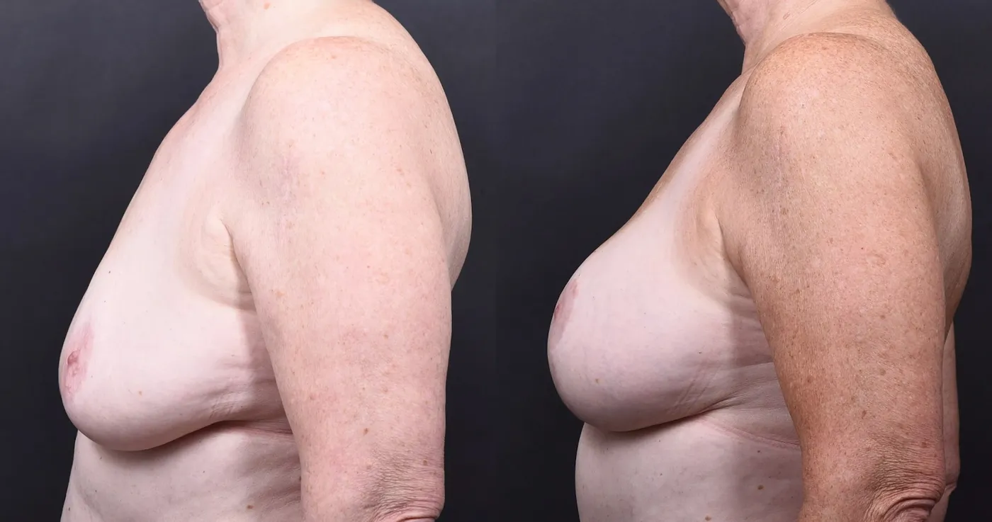 Austin Breast Augmentation With a Breast Lift Before & After Gallery - Patient 438571 - Image 5 - The Piazza Center
