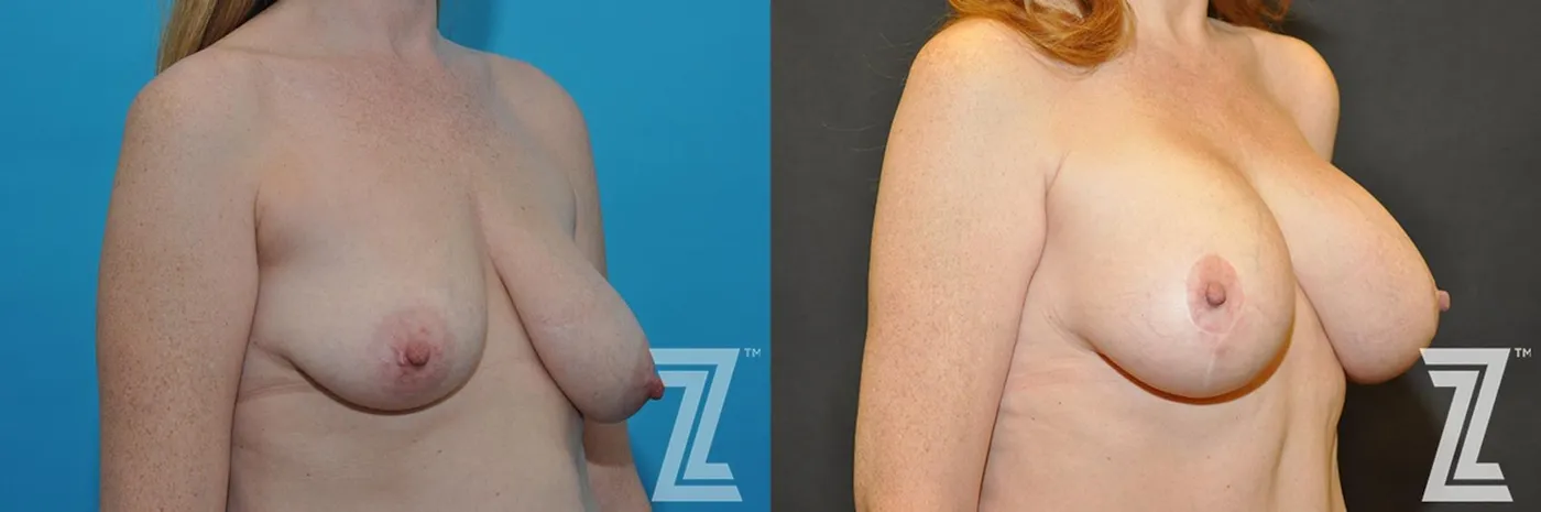 Austin Correction of Breast Asymmetry Before & After Gallery - Patient 132886778 - Image 4 - The Piazza Center