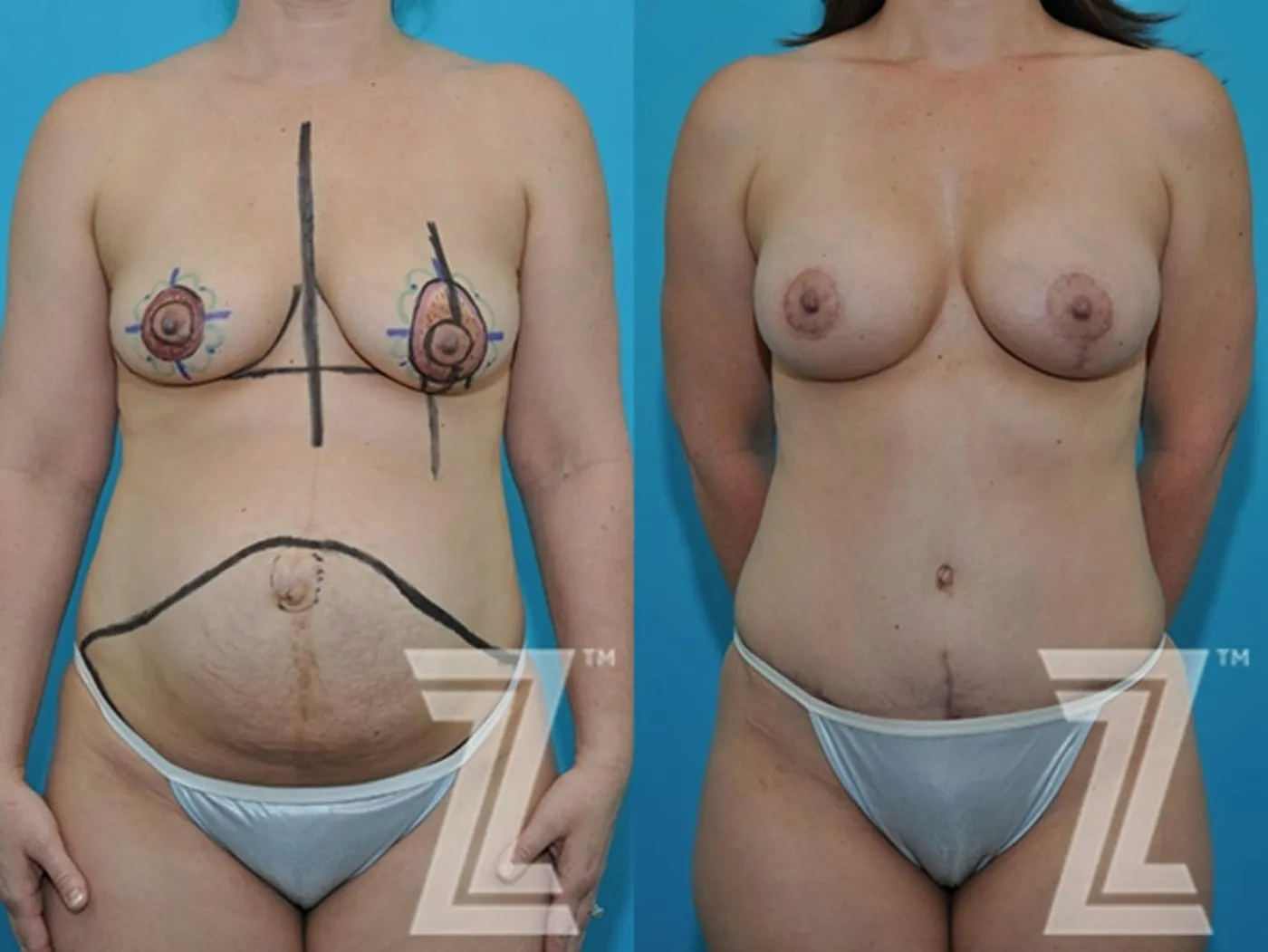 Austin Full Frontal view before & after 3 month post op 39 year old woman mommy make over - The Piazza Center, Austin TX - The Piazza Center