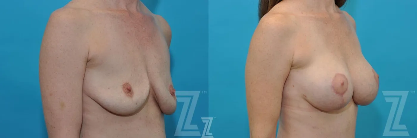 Austin before & after oblique view images of breasts of 35 year old woman mommy make over - Dr. Rocco Piazza Austin TX - The Piazza Center