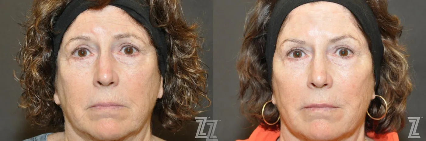 Austin Injectable Fillers Before & After Gallery - Patient 132963098 - Image 1 - The Piazza Center
