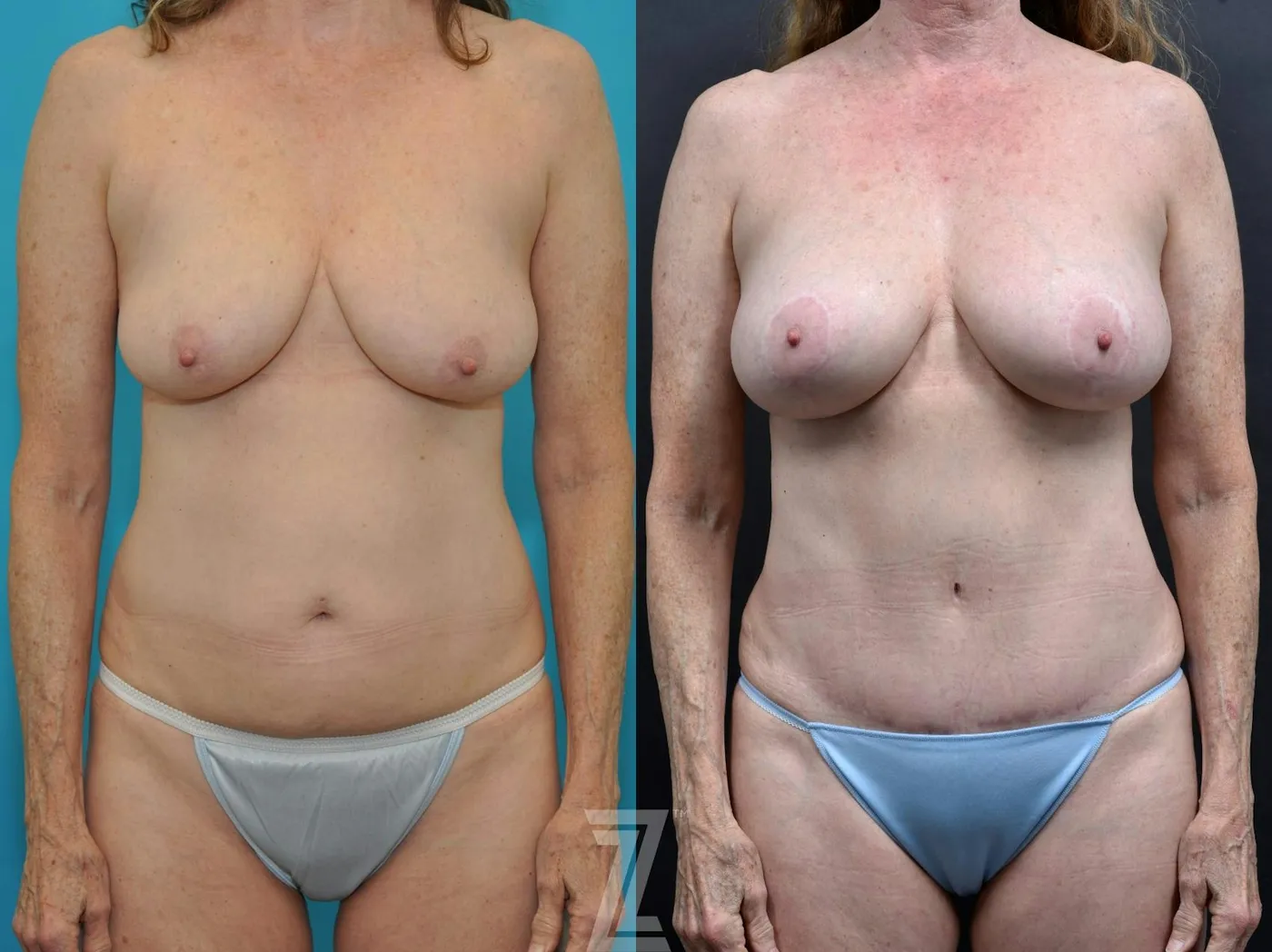 Austin Frontal full body view 7 year post op mommy makeover - The Piazza Center, Austin Tx - The Piazza Center