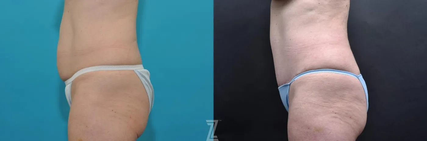 Austin Lateral abdominal view 7 year post op mommy makeover - The Piazza Center, Austin Tx - The Piazza Center