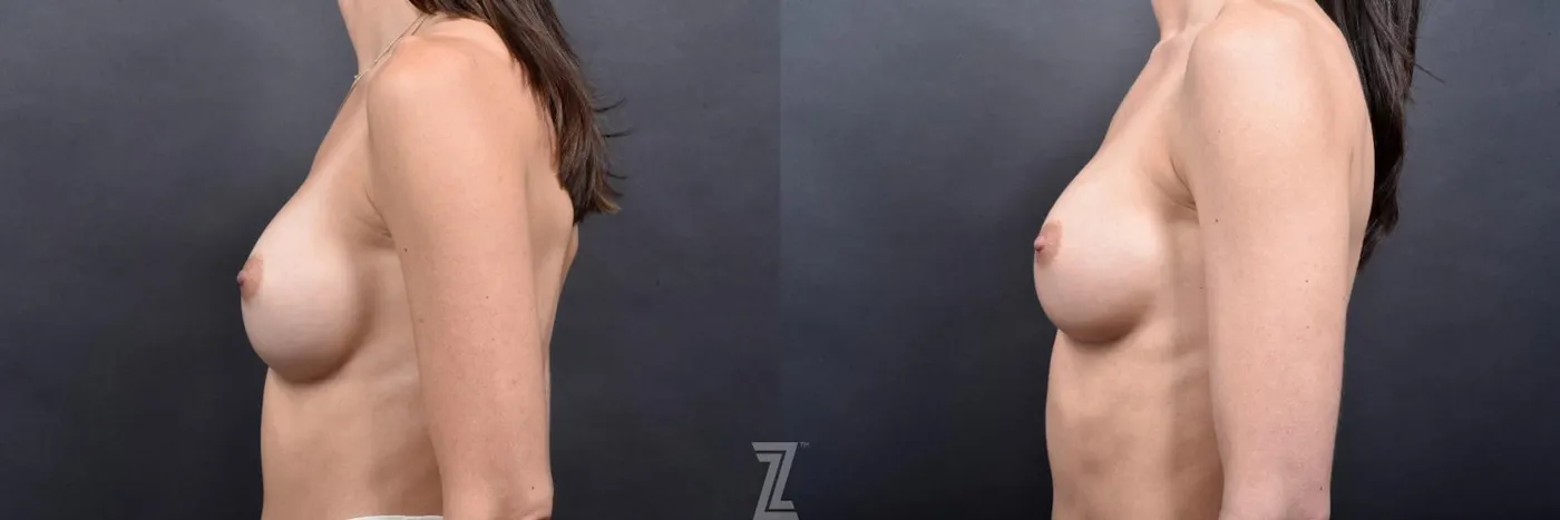 Austin Breast Augmentation Revision Before & After Gallery - Patient 132886545 - Image 3 - The Piazza Center