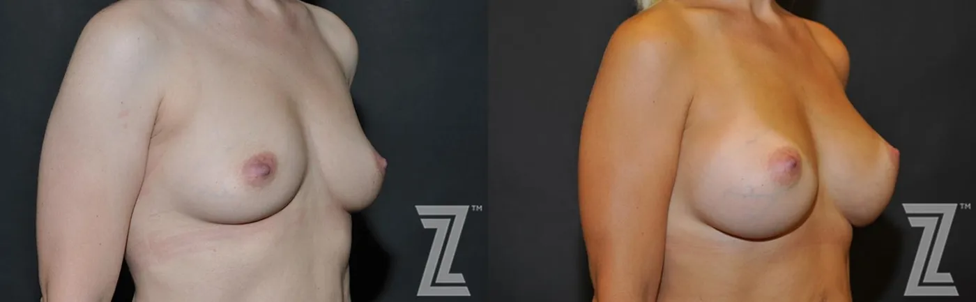 Austin 6 Months After Breast Augmentation in Austin, TX Before & After by Dr. Rocco Piazza - Oblique View - The Piazza Center