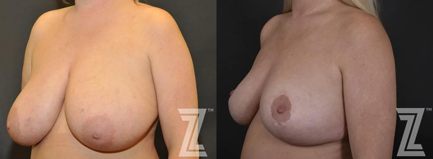 Austin Breast Reduction Before & After Gallery - Patient 132886746 - Image 2 - The Piazza Center