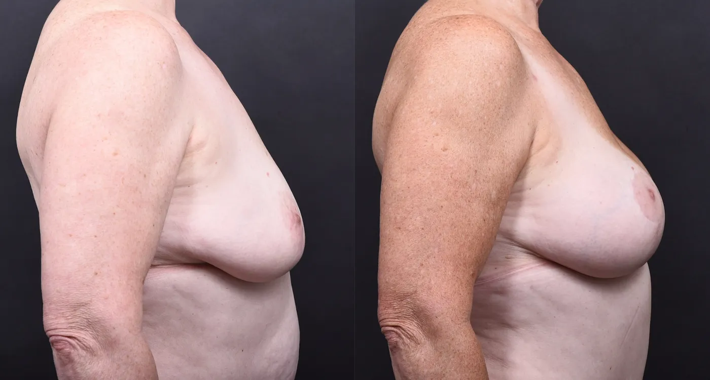 Austin Breast Augmentation With a Breast Lift Before & After Gallery - Patient 438571 - Image 3 - The Piazza Center