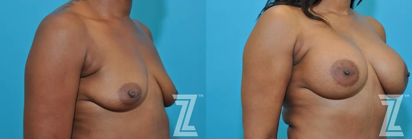 Austin 2 year post op oblique view breast view of 43-year-old mother of two mommy maker over - Dr. Rocco Piazza - The Piazza Center