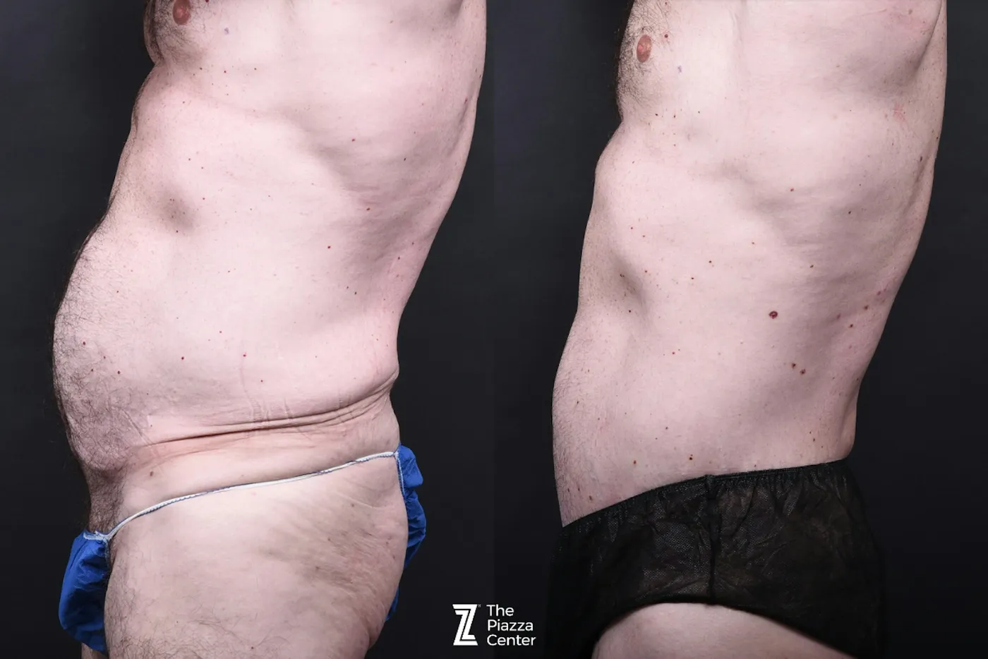 Austin Liposuction Before & After Gallery - Patient 294040 - Image 2 - The Piazza Center