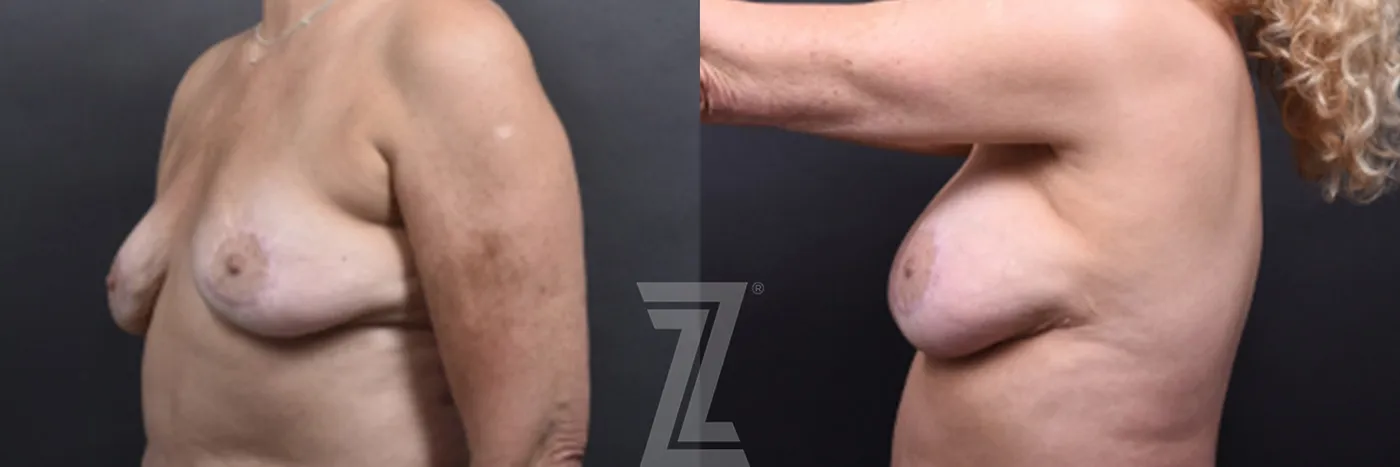 Austin Fat Transfer Breast Augmentation Before & After Gallery - Patient 311307 - Image 3 - The Piazza Center