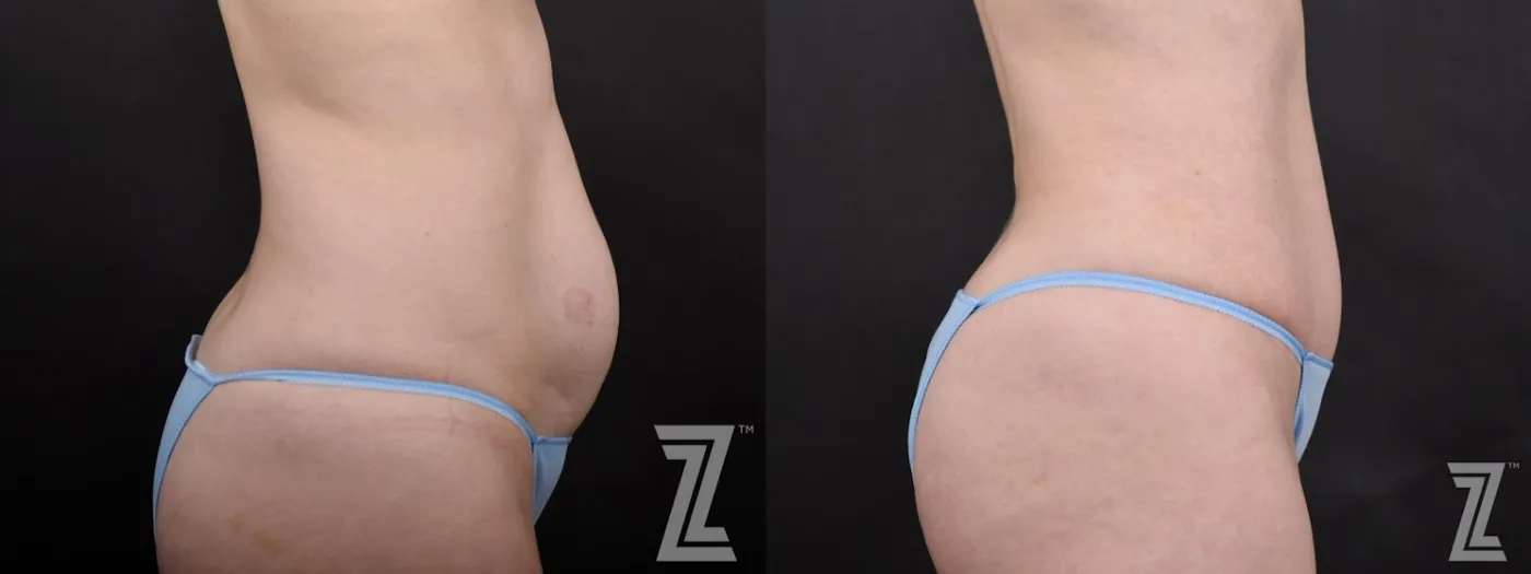 Austin Lateral View of Tummy from Mommy Makeover with Surgical Plan for a Breast Augmentation and a Contoured Waistline With an Abdominoplasty in Austin, TX by Dr. Rocco Piazza - Before & After Image - The Piazza Center