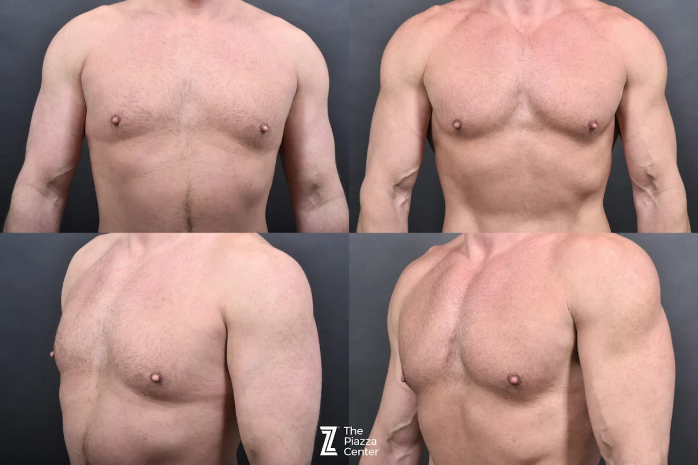Austin Liposuction Before & After Gallery - Patient 355670 - Image 7 - The Piazza Center