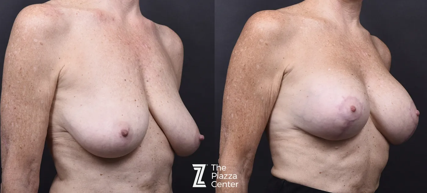 Austin Breast Augmentation With a Breast Lift Before & After Gallery - Patient 296286 - Image 2 - The Piazza Center