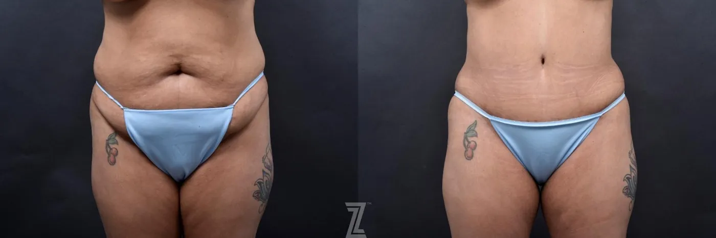 Austin Front Abdomen View 6 Month Post-OP Mommy Makeover in Austin, TX by Dr. Rocco Piazza - The Piazza Center