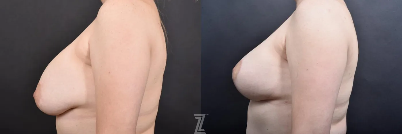 Austin Breast Augmentation Revision Before & After Gallery - Patient 132886548 - Image 3 - The Piazza Center