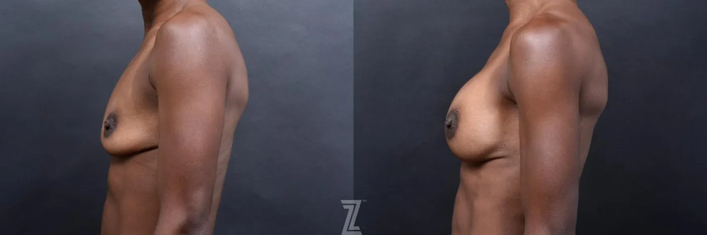 Austin side view of before and after view of 33 year old athletic mom of two children breast augmentation - The Piazza Center