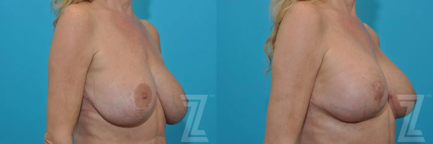 Austin Breast Augmentation Revision Before & After Gallery - Patient 132886579 - Image 4 - The Piazza Center