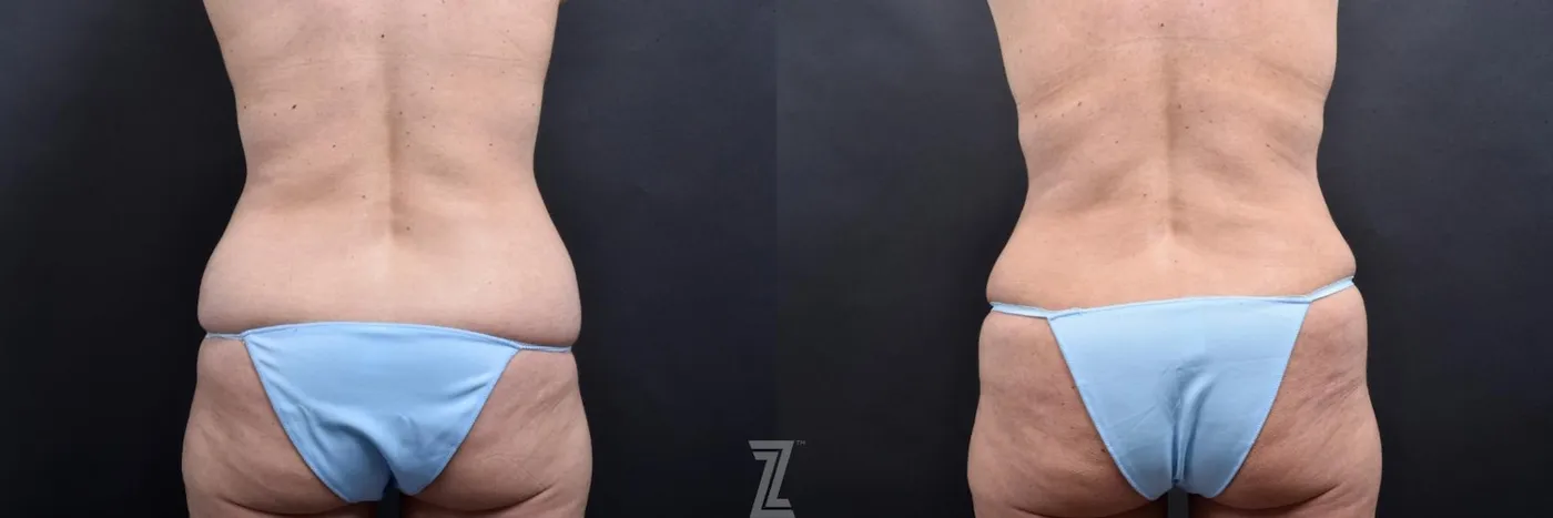 Austin Posterior View from Mommy Makeover of 41 year old woman in Austin, TX by Dr. Rocco Piazza - Before & After - The Piazza Center