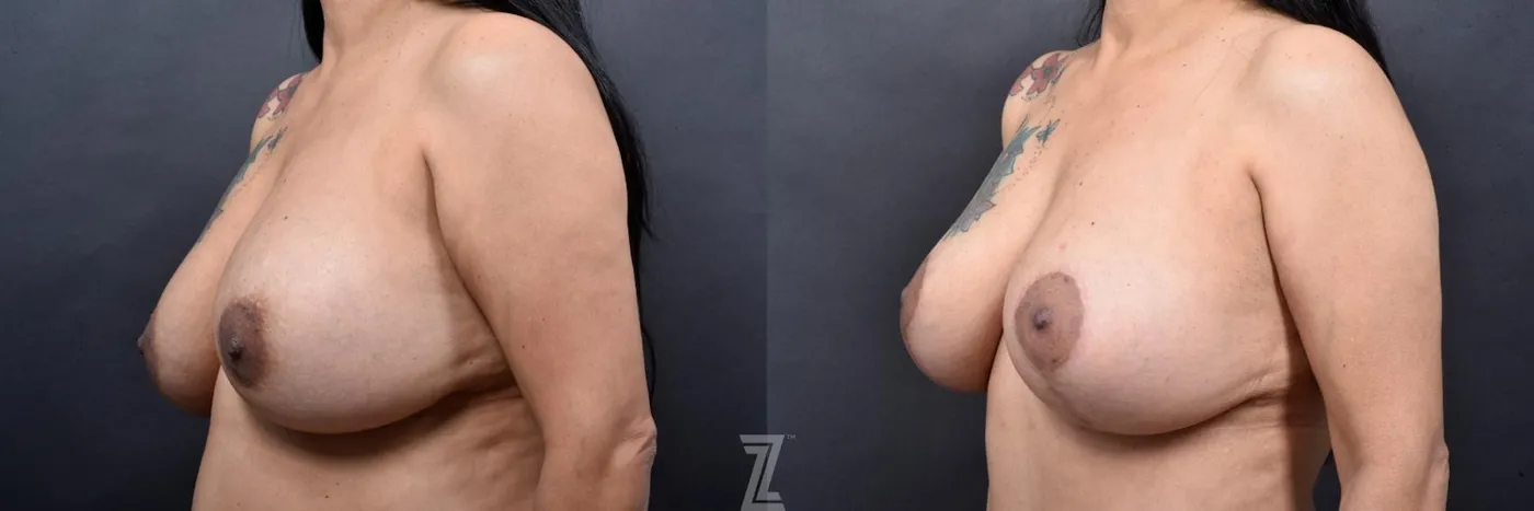 Austin 6 Month Post-OP Mommy Makeover in Austin, TX by Dr. Rocco Piazza - Oblique View of Breasts - The Piazza Center