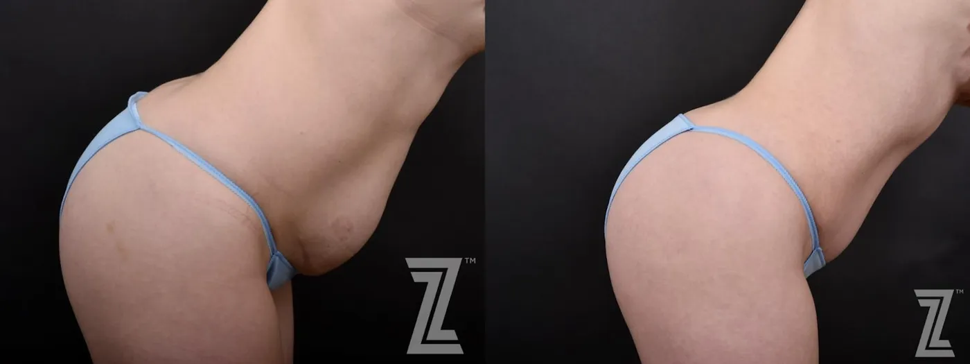 Austin Lateral View of Tummy in Flexion from Mommy Makeover with Surgical Plan for a Breast Augmentation and a Contoured Waistline With an Abdominoplasty in Austin, TX by Dr. Rocco Piazza - Before & After - Image - The Piazza Center