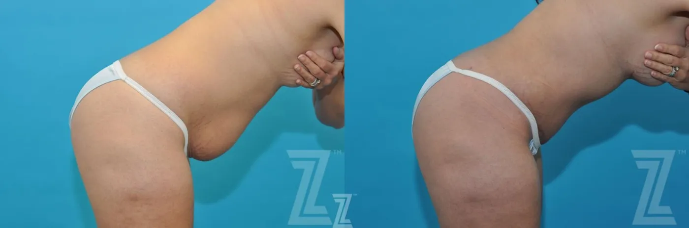 Austin Before & After images of 40-year-old mother of five mommy maker over oblique flexion view - Dr. Rocco Piazza, Austin TX - The Piazza Center