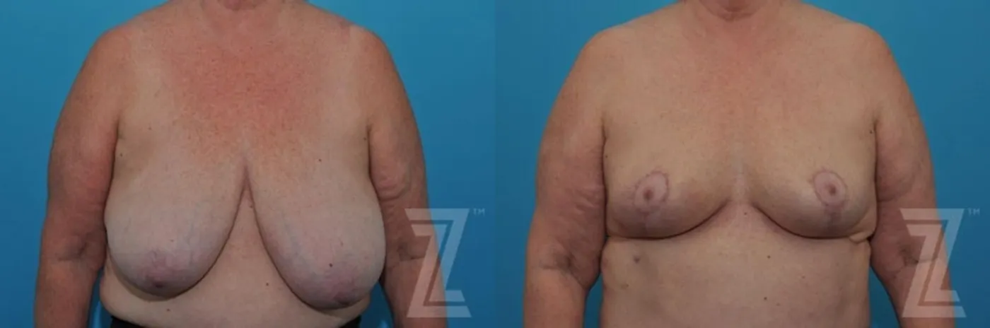 Austin Breast Reduction Before & After Gallery - Patient 132886611 - Image 1 - The Piazza Center