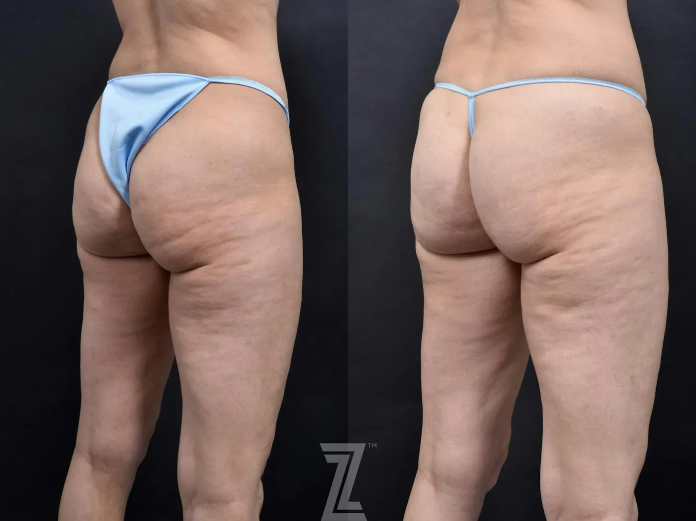 Austin Avéli Before & After Gallery - Patient 132905407 - Image 3 - The Piazza Center