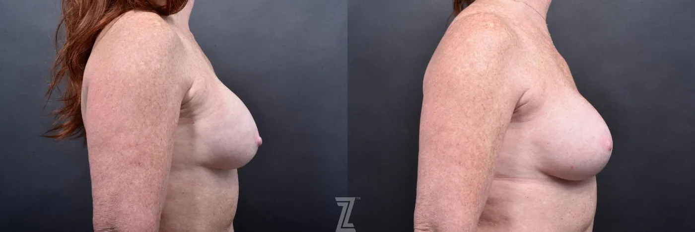 Austin Breast Augmentation Revision Before & After Gallery - Patient 132886568 - Image 5 - The Piazza Center