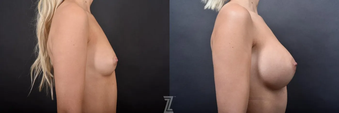 Austin Side view of before and after images of Silicone Implants with Cohesive Silicone Gel on 27 year old woman at the piazza center - The Piazza Center