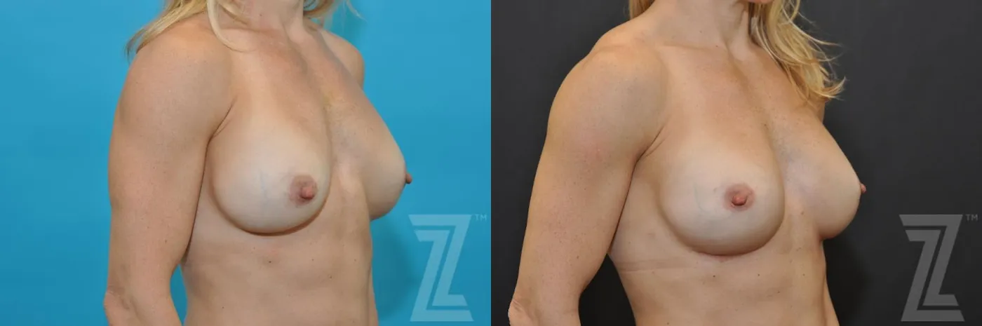 Austin Breast Augmentation Revision Before & After Gallery - Patient 132886580 - Image 4 - The Piazza Center