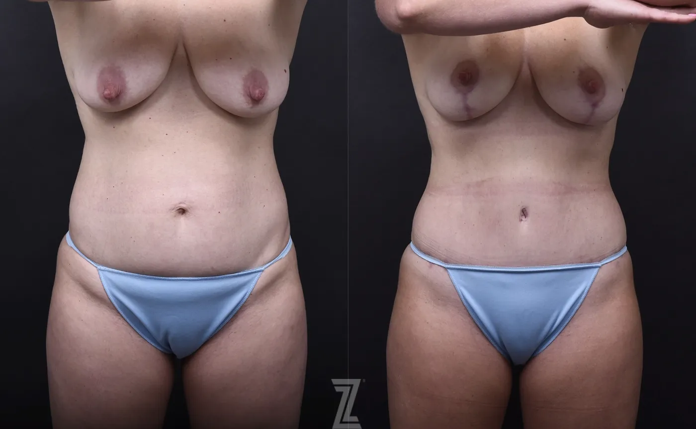 Austin Mommy Makeover Before & After Gallery - Patient 851555 - Image 1 - The Piazza Center