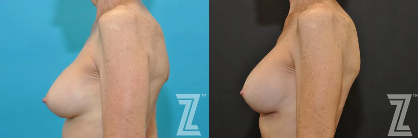 Austin Breast Augmentation Revision Before & After Gallery - Patient 132793347 - Image 3 - The Piazza Center