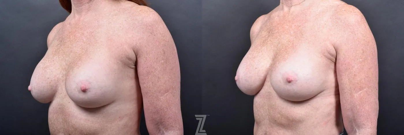 Austin Breast Augmentation Revision Before & After Gallery - Patient 132886568 - Image 2 - The Piazza Center