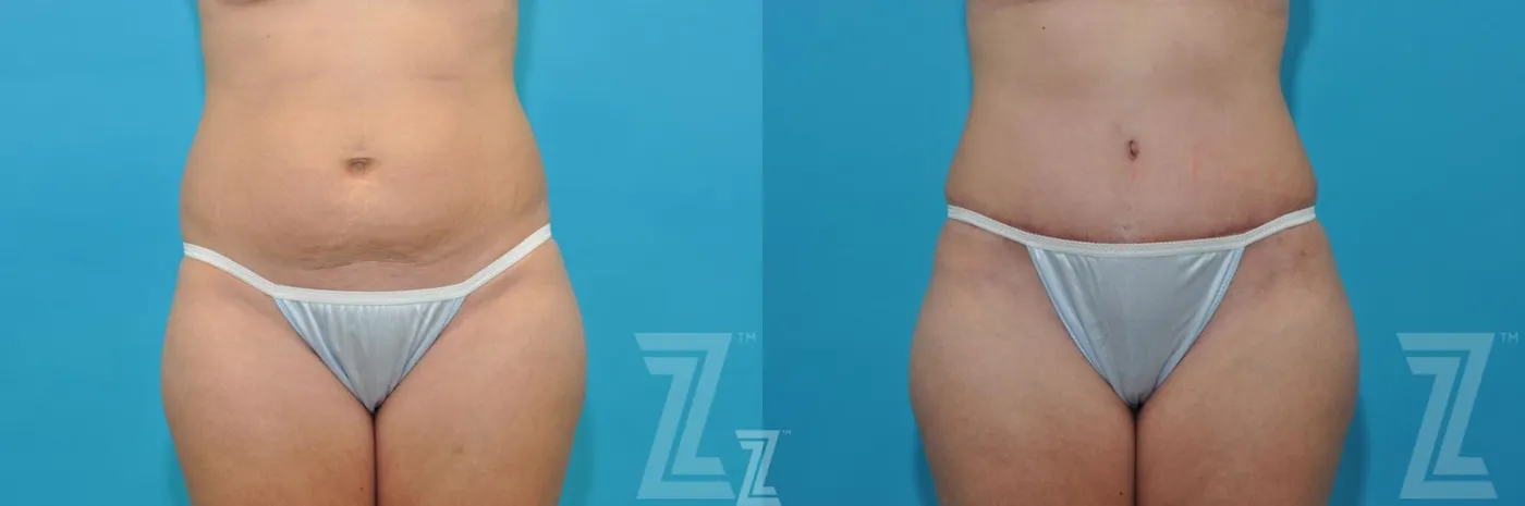 Austin Before & After images frontal abdominal view of 40-year-old mother of five mommy maker over - Dr. Rocco Piazza, Austin TX - The Piazza Center